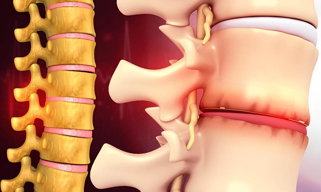 Degenerative Disc Disease Treatment Miami