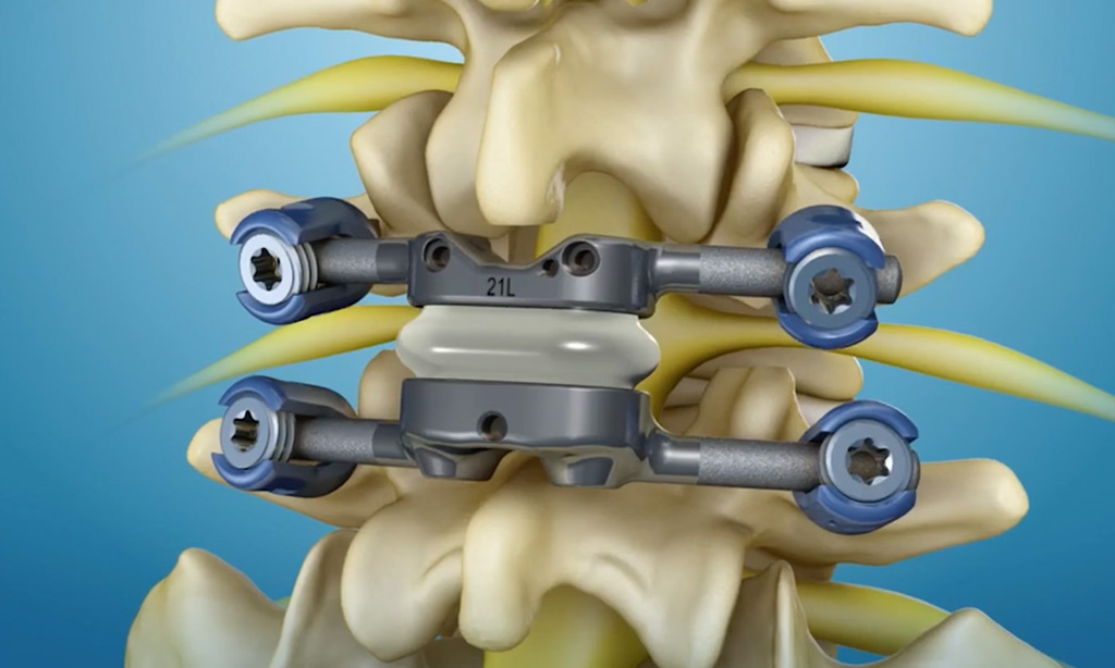 Lumbar Disc Replacement Miami