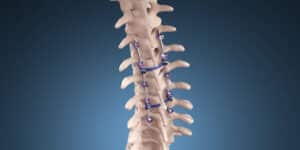 Scoliosis Surgery: Treatment Cost & Recovery Time 