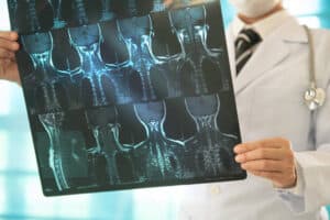 Cervical Spondylosis Surgery: Treatment Cost & Recovery Time