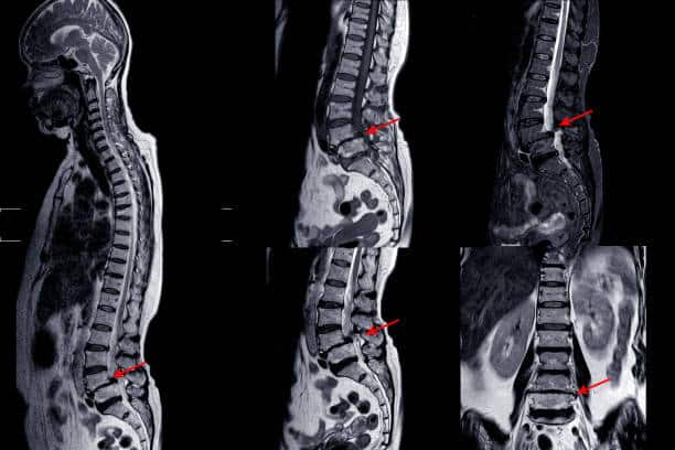Cervical Spondylosis Treatment Miami