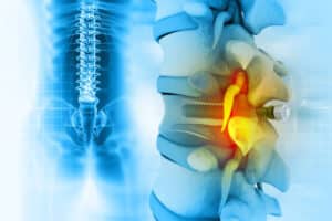 Spinal Stenosis Surgery: Treatment Cost & Recovery Time