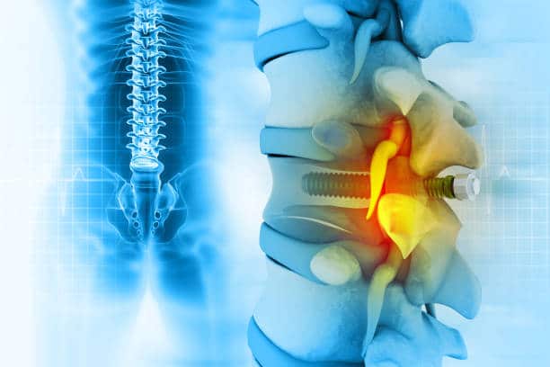 Spinal Stenosis Surgery: Treatment Cost & Recovery Time
