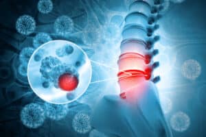 Spine Tumors: Symptoms, Treatment & Recovery Time