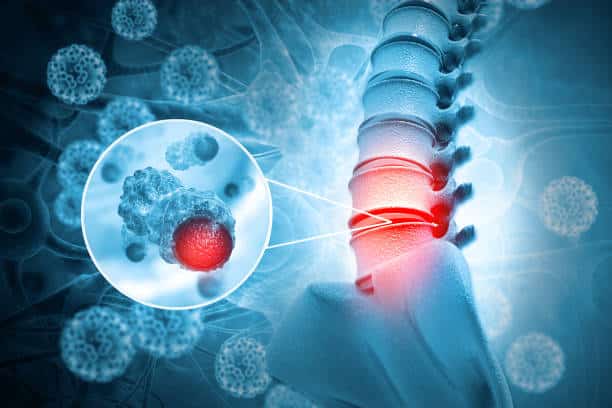 Spine Tumors: Symptoms, Treatment & Recovery Time
