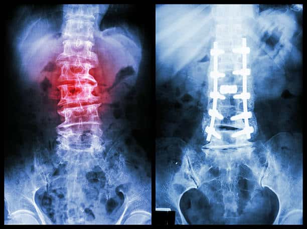 Spondylolisthesis Surgery: Treatment Cost & Recovery Time