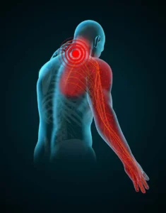 Neck Pain and Cervical Radiculopathy: When to Worry and When to Treat Conservatively
