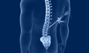 What Patients Should Ask Before Agreeing to Spine Surgery