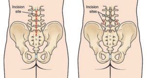 Endoscopic Spine Surgery vs. Traditional Open Fusion