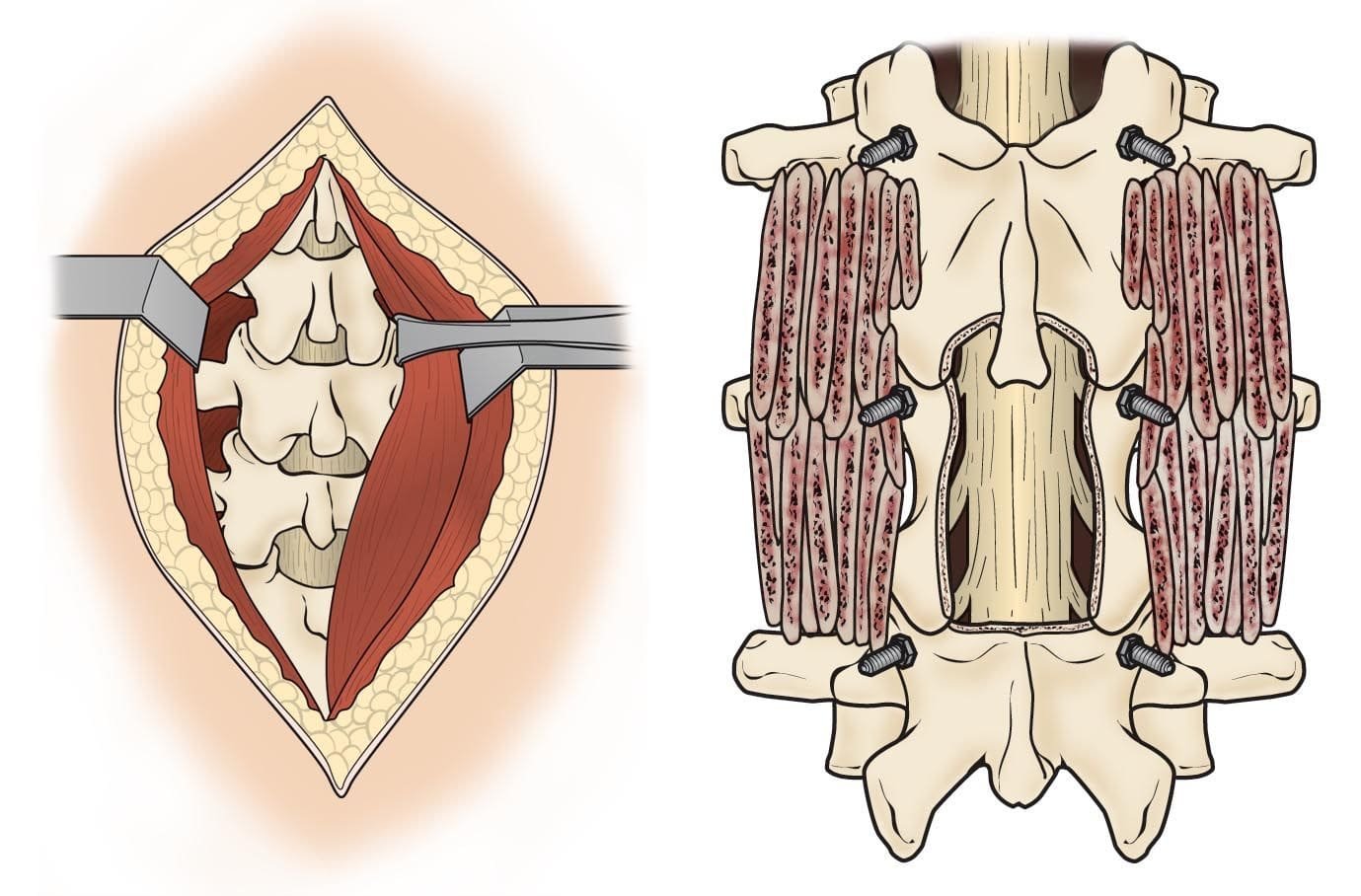 Endoscopic Spine Surgery vs. Traditional Open Fusion