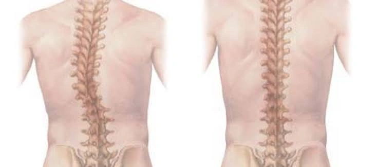 Managing Adult Degenerative Scoliosis