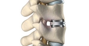Artificial Cervical Disc Replacement