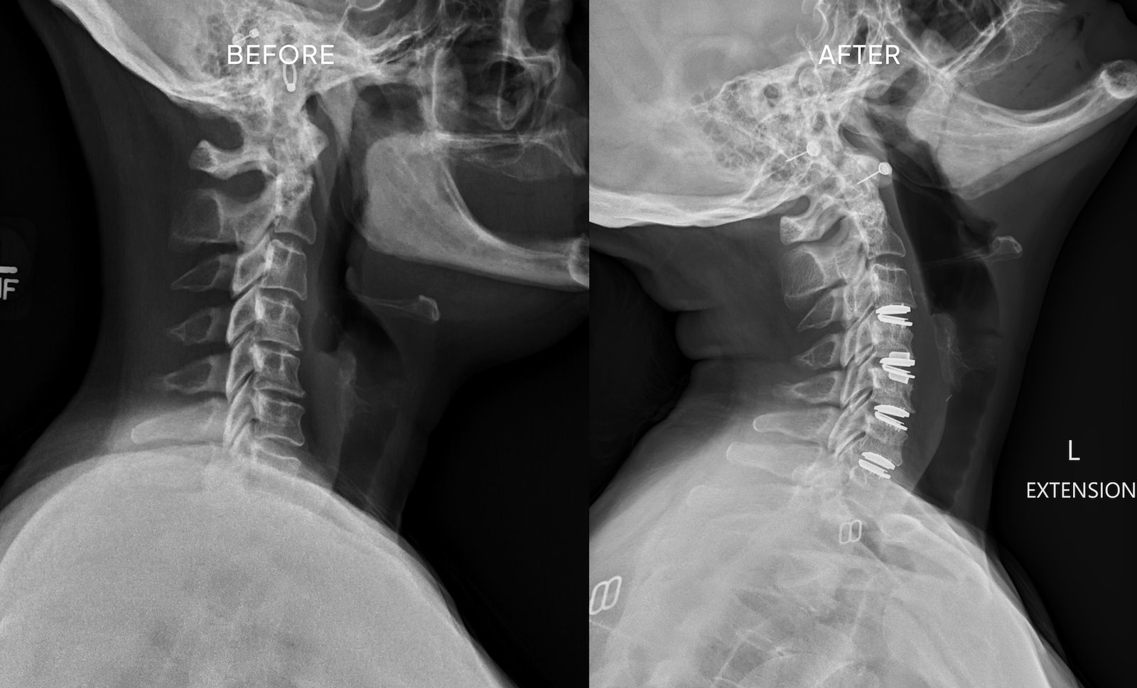 Artificial Cervical Disc Replacement