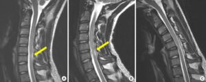 Cervical Myelopathy Spinal Cord Compression