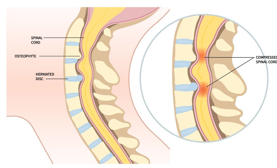 Cervical Myelopathy and Spinal Cord Compression