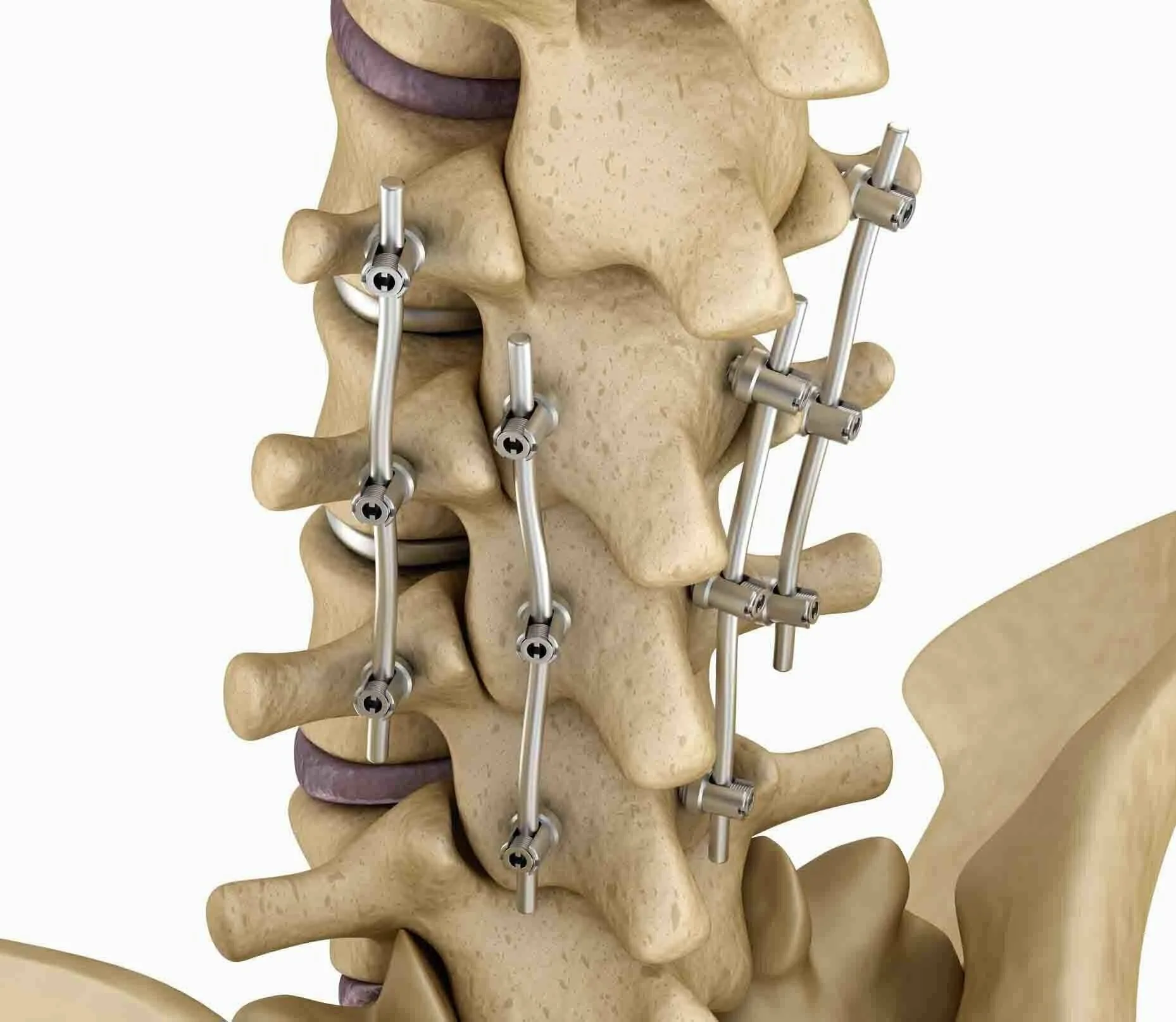 Navigating Revision Lumbar Spine Surgery