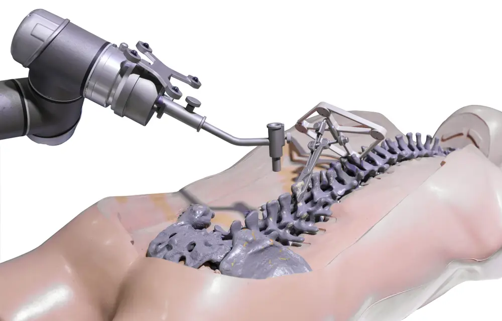 Robotic-Assisted Motion Preservation Surgery: Precision Alignment for Complex Spinal Stenosis