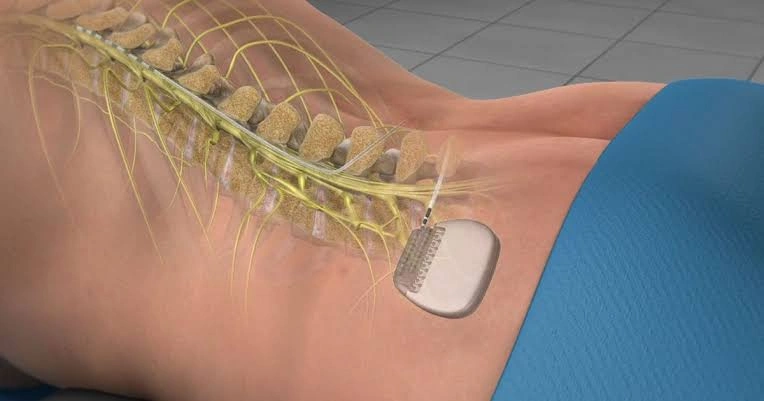 Spinal Cord Stimulation vs. Targeted Microdecompression
