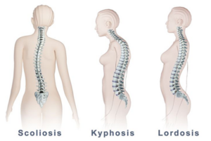 Adult Degenerative Scoliosis