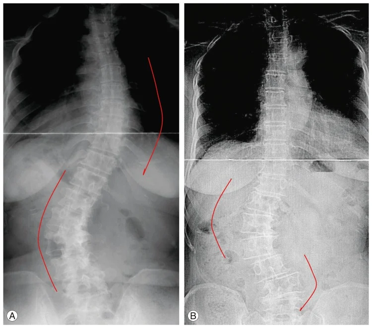 Adult Degenerative Scoliosis