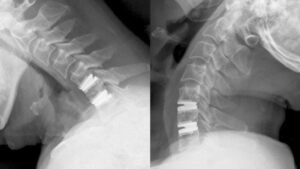 cervical-disc-arthroplasty-vs-acdf