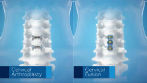 cervical-disc-arthroplasty-vs-acdf