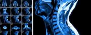Navigating Cervical Spondylotic Myelopathy