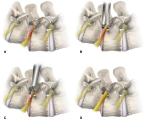 Endoscopic Lumbar Foraminotomy