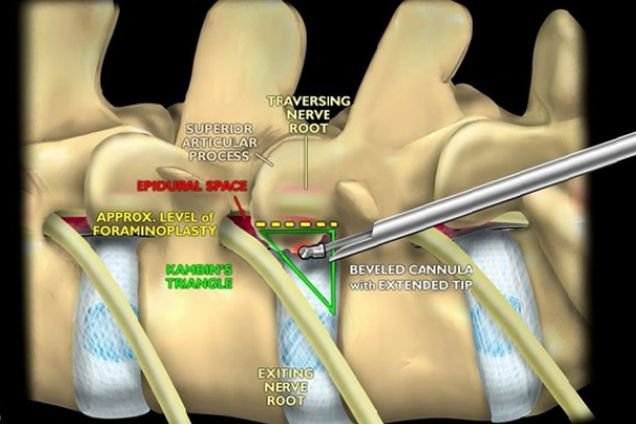 Endoscopic Lumbar Foraminotomy