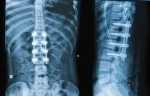 Is Fusion Always Necessary for Spondylolisthesis? Motion-Preserving Decompression vs. Stabilization Options