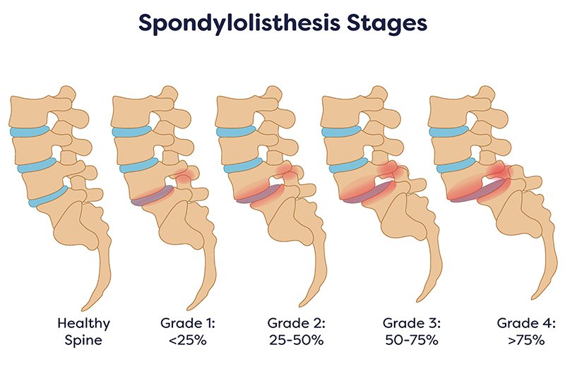 Is Fusion Always Necessary for Spondylolisthesis? Motion-Preserving Decompression vs. Stabilization Options