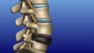 Lateral Lumbar Interbody Fusion (LLIF/XLIF): Indirect Neural Decompression While Sparing Posterior Paraspinal Muscles