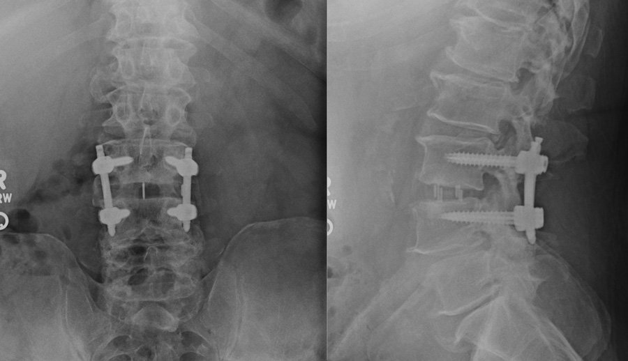 Lateral Lumbar Interbody Fusion (LLIF/XLIF): Indirect Neural Decompression While Sparing Posterior Paraspinal Muscles