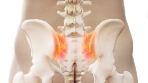Managing Sacroiliac (SI) Joint Dysfunction