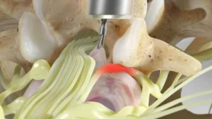 Minimally Invasive Tubular Microdiscectomy