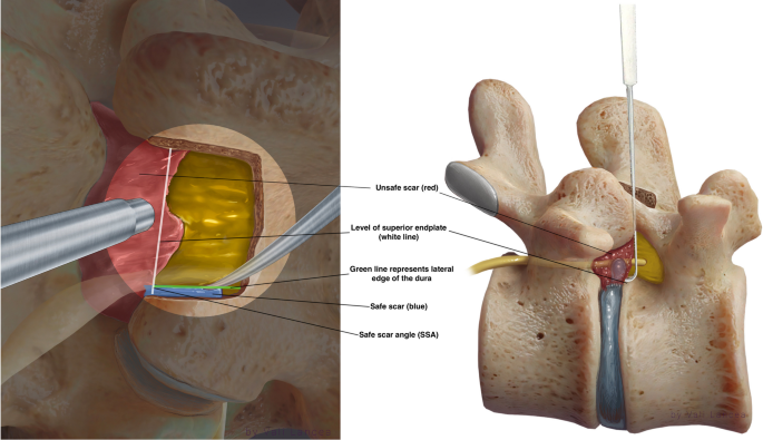 Minimally Invasive Tubular Microdiscectomy