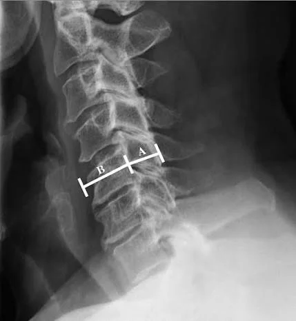 Navigating Cervical Spondylotic Myelopathy