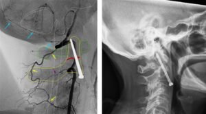 Surgical Management of Odontoid Fractures and Upper Cervical Instability: Evidence-Based Trajectory for Optimal Fusion