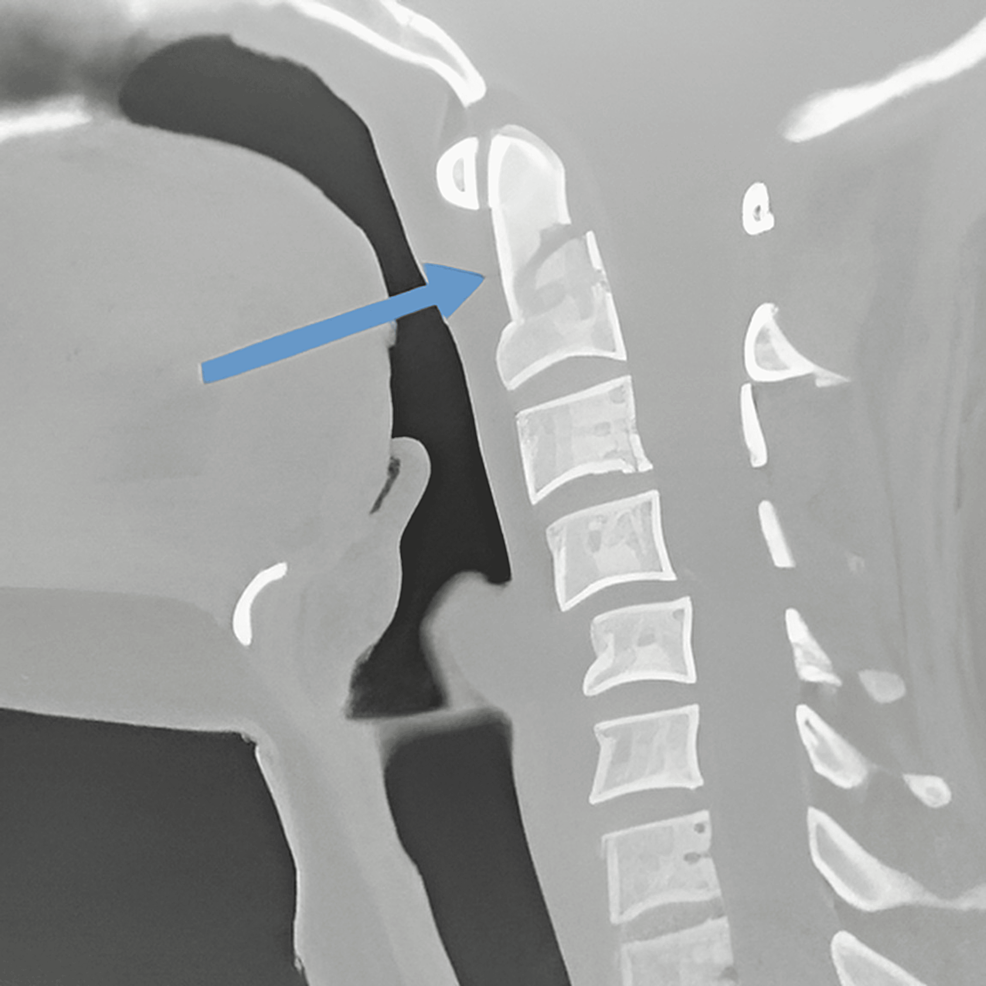 Surgical Management of Odontoid Fractures and Upper Cervical Instability: Evidence-Based Trajectory for Optimal Fusion