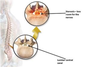 Lumbar Spinal Stenosis and Neurogenic Claudication